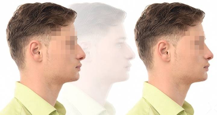 Rinoplastia masculina