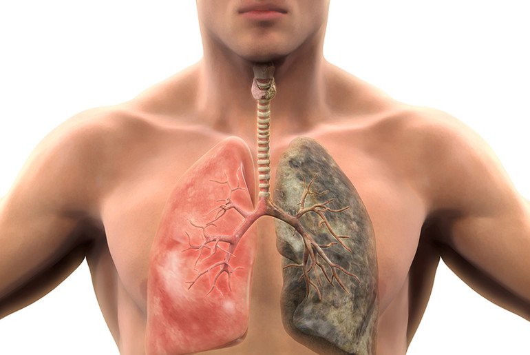 Muitas vezes, é durante uma grande crise infecciosa pulmonar que os fumantes descobrem sofrer de BPCO. A doença pode ser grave.