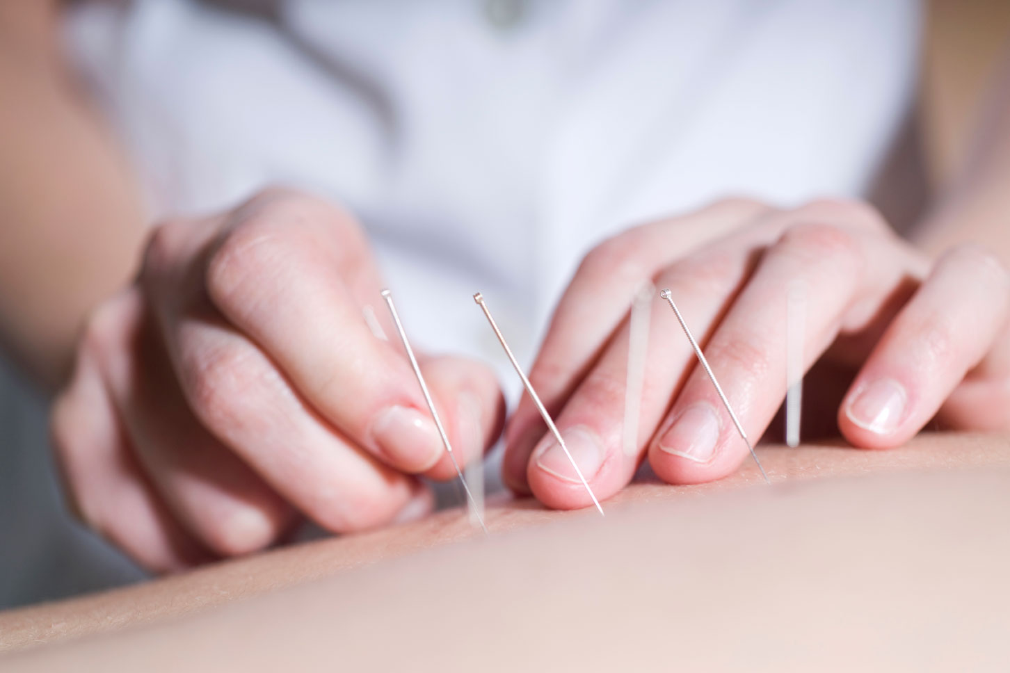 A acupuntura é uma prática milenar baseada nos pilares da Medicina Tradicional Chinesa