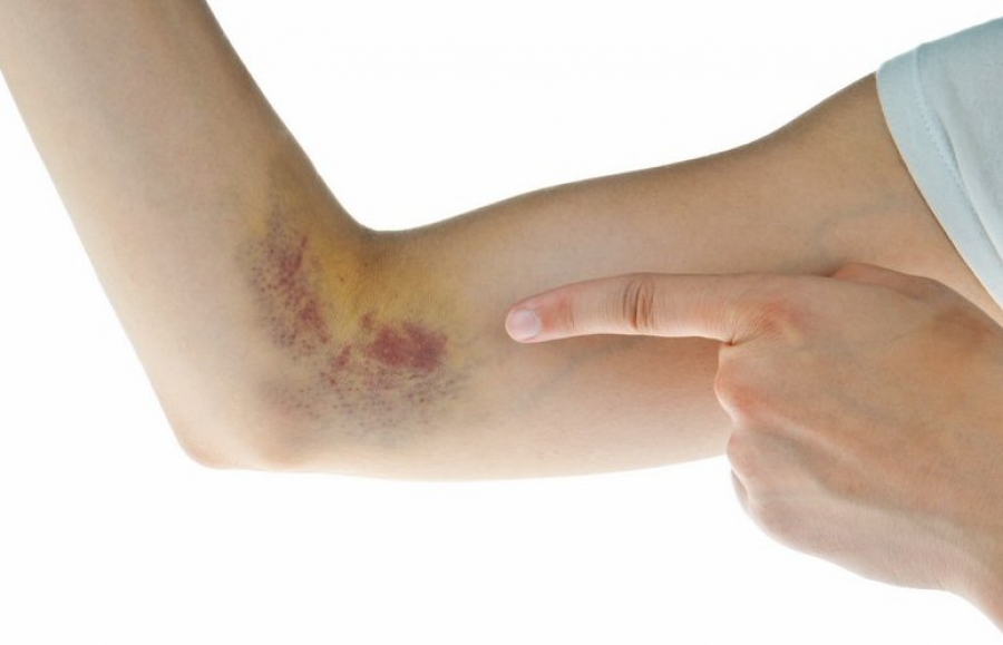 Hematoma