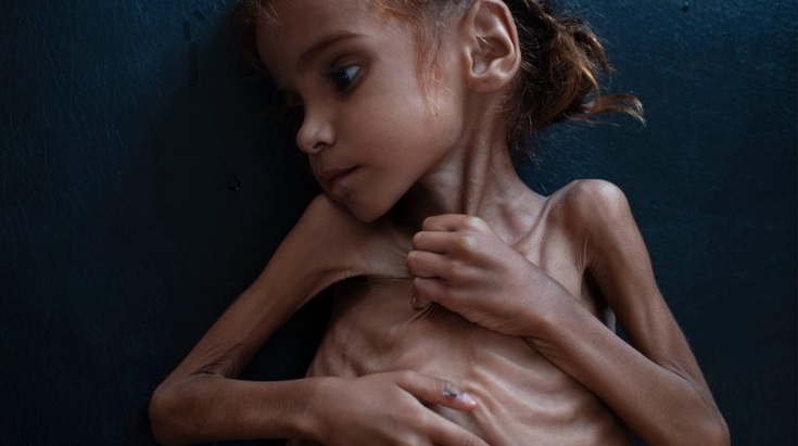 Amal Hussain morreu de fome por causa da guerra no Iêmen
