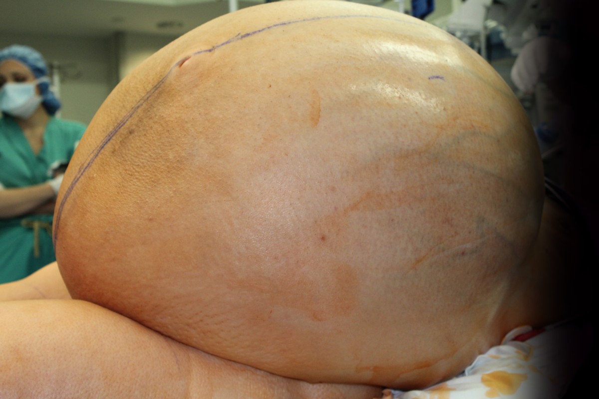 Médicos retiram tumor de 27 kg