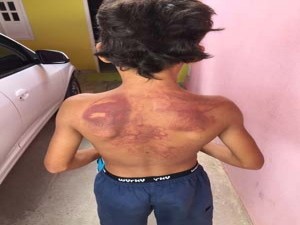 Criança mostra as marcas nas costas deixadas com o espancamento