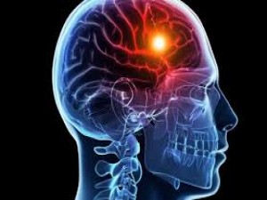 O acidente vascular cerebral (sigla: AVC) vulgarmente chamado de derrame cerebral, é caracterizado pela perda rápida de função neurológica, decorrente