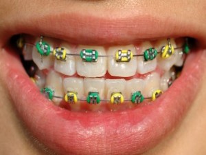 Aparelhos dentários podem dá problemas