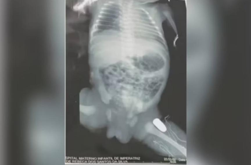 Bala ficou alojada na perna do bebê