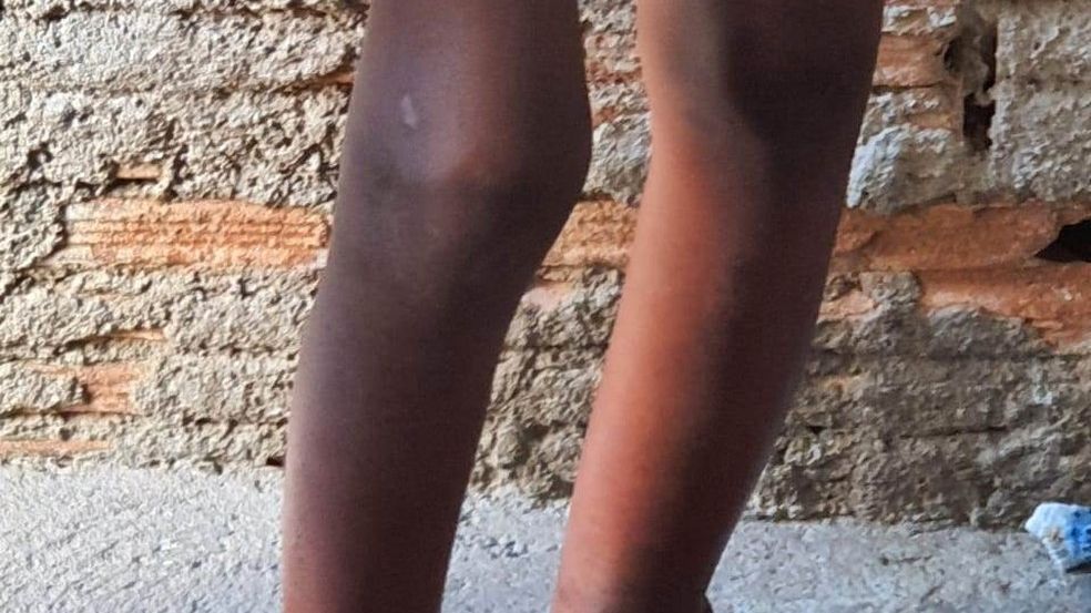 A criança, conforme a PM, ficava impossibilitada de sentar ou agachar e, com isso, também apresentava pernas inchadas