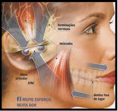 Disfunções da Articulação Temporo Mandibular