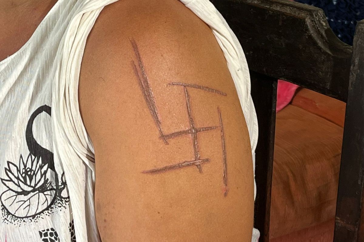 Mulher teve o símbolo nazista marcado com faca quente