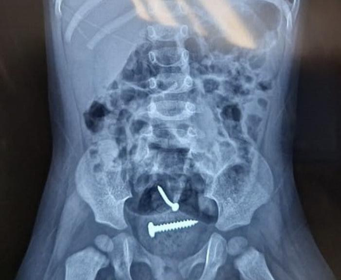 Exame de Raio-X mostra parafusos dentro do corpo da criança