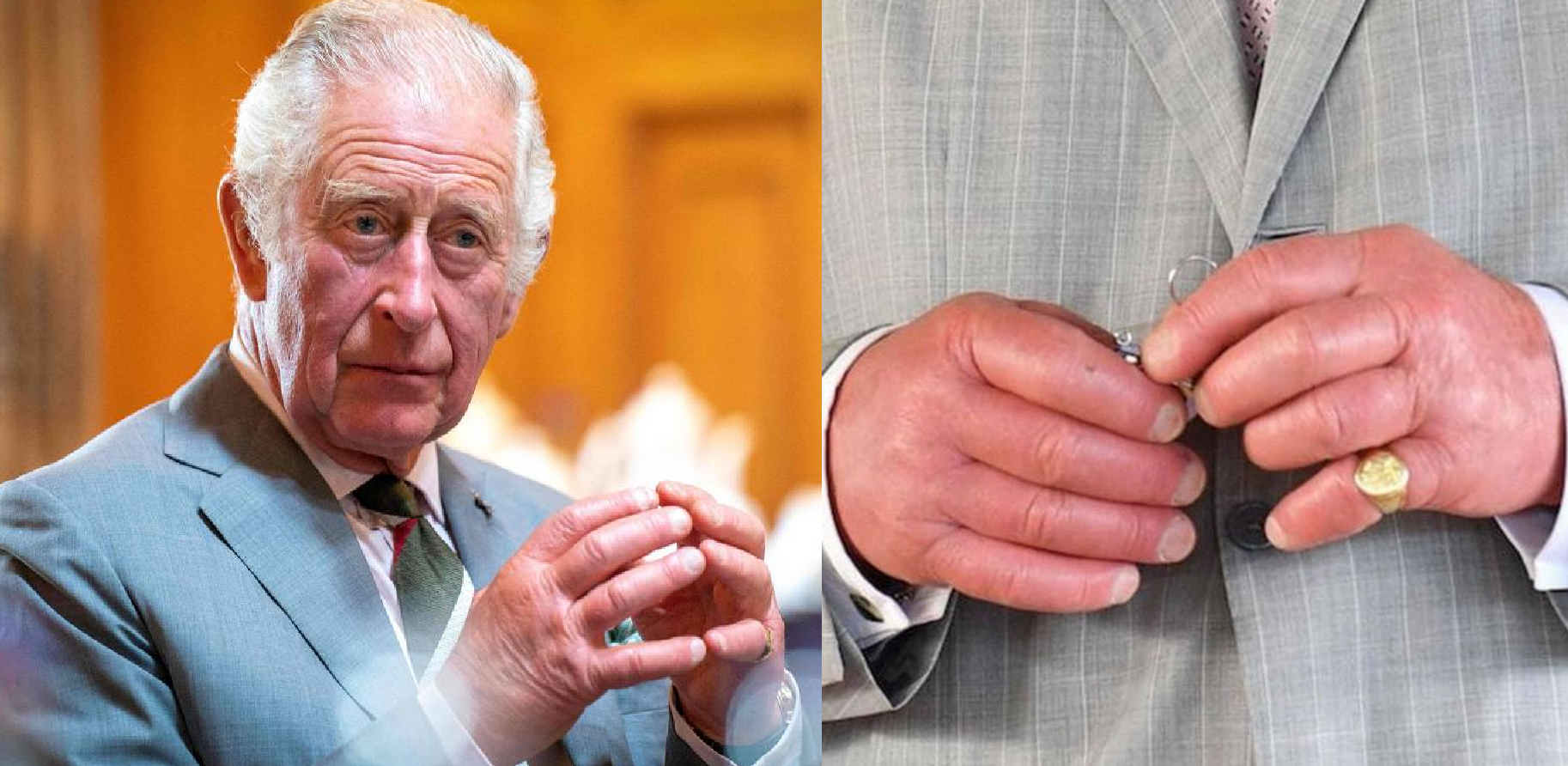 Inchaço nas mães do Rei Charles III preocupa