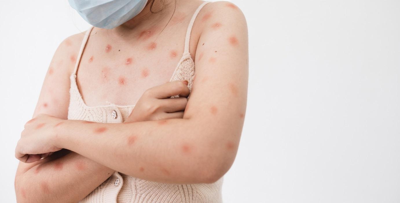 Saúde confirma primeiro caso de nova cepa de mpox no Brasil