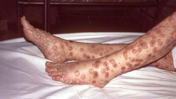 Varíola do Macaco causa erupção cutânea no corpo