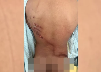 “Pensei que ia morrer”: adolescente é gravemente ferido por raio durante ato de Nikolas