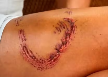 Advogada mordida por tubarão em Noronha mostra marcas na coxa; 