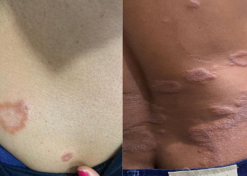 Piauienses estão entre os mais diagnosticados com hanseníase no país; conheça os sintomas