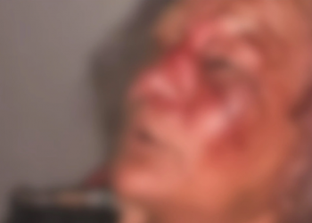 Idosa é brutalmente agredida durante assalto dentro de casa no interior do Piauí