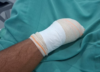 Mototaxista é acusado de decepar mão de vizinho durante briga por terreno em Campo Maior