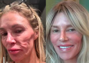 Estrela de reality show diz ter consultado 21 médicos por causa de 'derretimento' no rosto