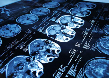 10 fatos que você precisa saber sobre tumor cerebral