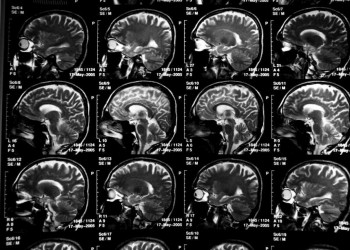 Aneurisma vs. Acidente Vascular Cerebral: quais as diferenças?