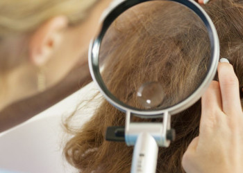 Exame dos fios de cabelo pode indicar os melhores tratamentos