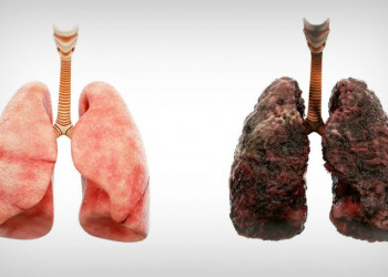 Câncer de pulmão está associado em 90% dos casos ao tabagismo