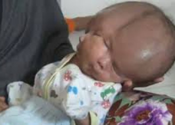 Bebê nasce com e dois cérebros e dois rostos na Indonésia