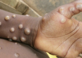 Casos de varíola do macaco chegam a 76 em todo o país