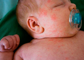 APLV: Conheça a alergia alimentar mais comum em bebês de até um ano