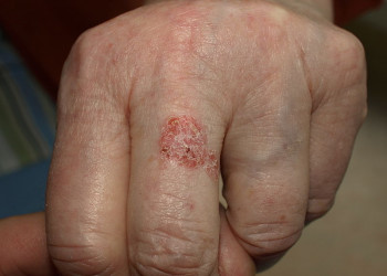 Dezembro Laranja alerta para prevalência do câncer de pele não melanoma no país