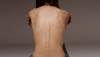 Anorexia nervosa: O papel da mente em distúrbios alimentares