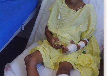 Menino de 9 anos tem perna amputada por causa de acidente com ônibus escolar no Piauí