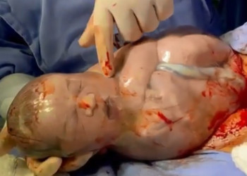 Vídeo de bebê empelicado sendo rompido viraliza na internet