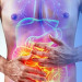 Doenças inflamatórias intestinais atingem mais de 10 milhões de pessoas no mundo