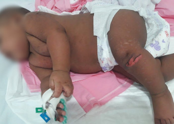 Bebê de Teresina com síndrome rara provocada por Chikungunya vira caso de estudo