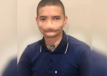 Jovem que perdeu parte do rosto em acidente com fogos de artifícios viraliza na internet