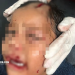 Criança de 2 anos é fica ferida ao ser atacada por cadela em Piripiri