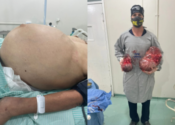 Médico retira tumores de 11kg de barriga de paciente em Floriano
