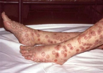 Homem de Parnaíba é o terceiro caso da varíola dos macacos no Piauí