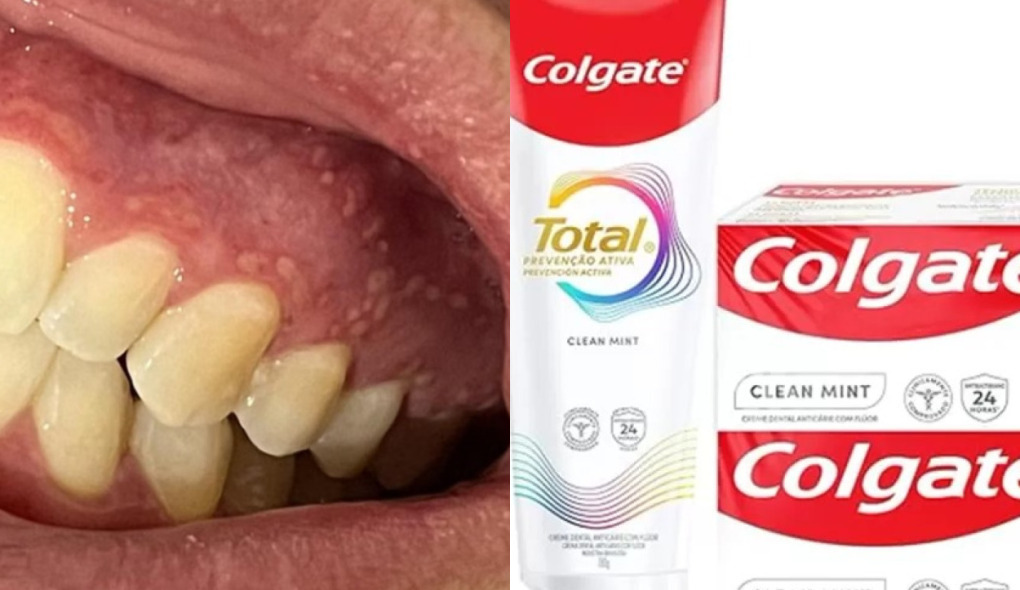 Lesões e inflamações após uso da nova fórmula do creme dental Colgate Total Proteção Ativa