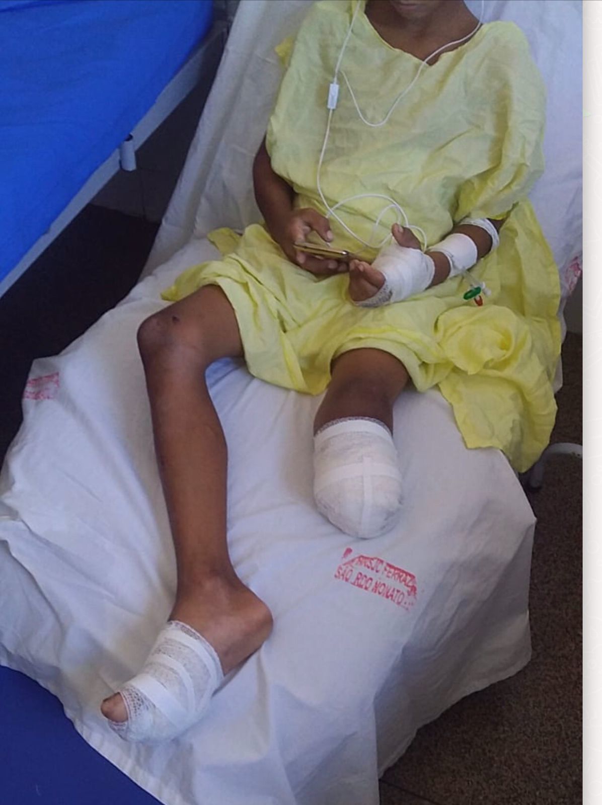 Criança de 9 anos tem perna amputada ao cair de ônibus