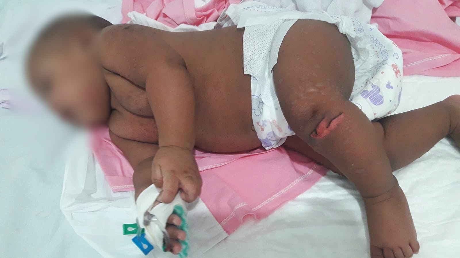 Bebê Lhuna enquanto se recuperava das lesões na pele