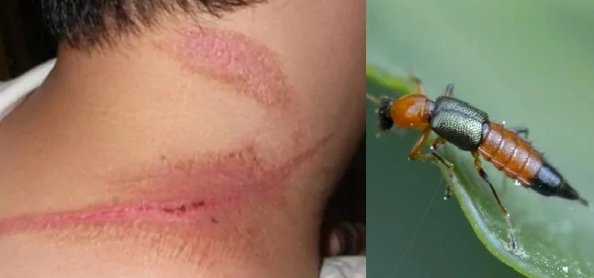 Potós causam queimaduras de até 2º grau na pele humana