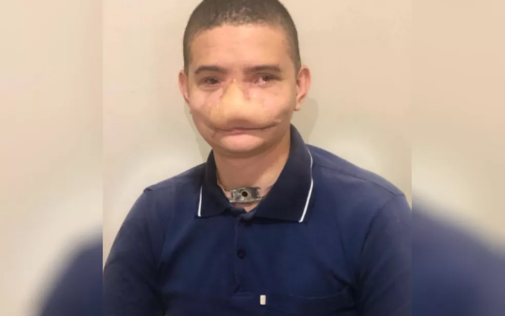 Jovem que perdeu parte do rosto ao ser atingido por fogos de artifício bomba na web