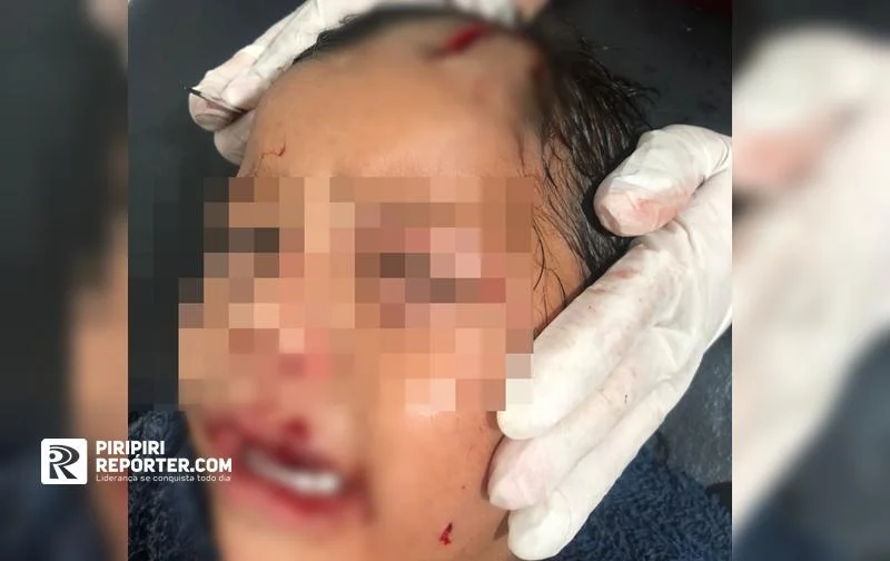 Criança fica ferida ao ser atacada por cão em Piripiri