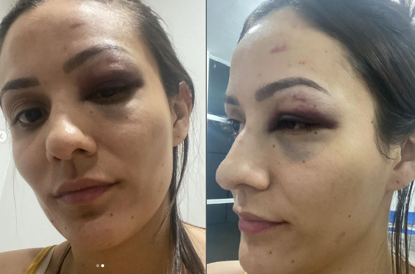 Carlene Nobre exibiu o rosto machucado nas redes sociais