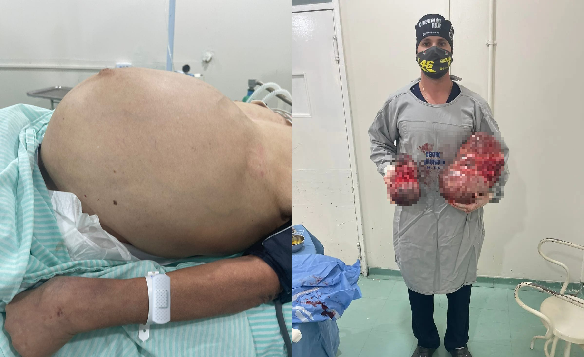 Médico retira tumores de barriga de paciente em Floriano
