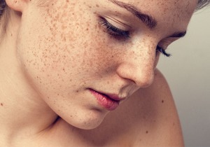 Segundo estudo, 35% das mulheres brasileiras sofrem de Melasma